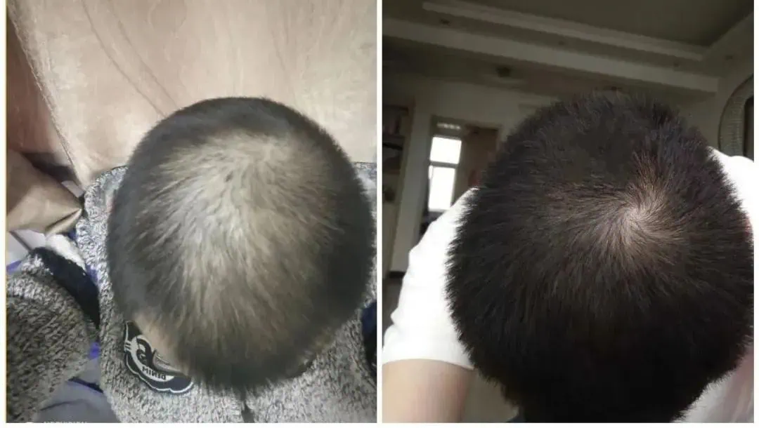 Kirkland 5% Minoxidil 男士生髮水 6支裝|Topical Solution:圖片 3