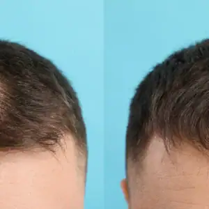 Kirkland 5% Minoxidil 男士生髮水 6支裝|Topical Solution:圖片 4