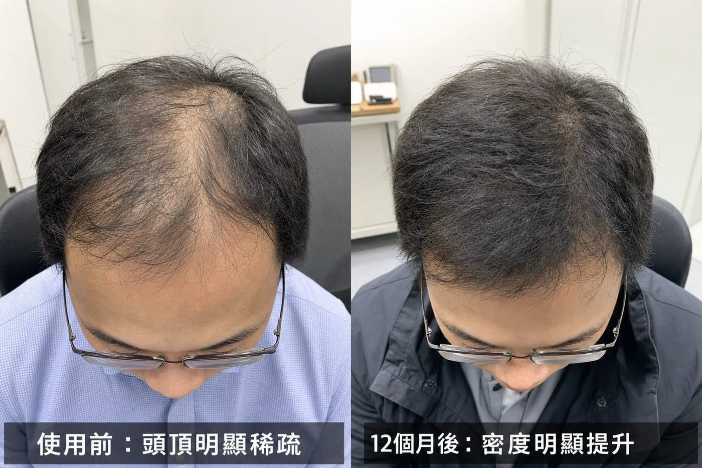 Kirkland 5% Minoxidil 男士生髮水 6支裝|Topical Solution:圖片 2